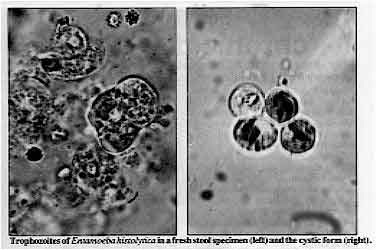 Trophozoites of Emtamoeba histolytica in a fresh stool specimen (left) and the cystic form (right).