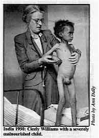 India 1950: Cicely Williams with a severely malnourished child.