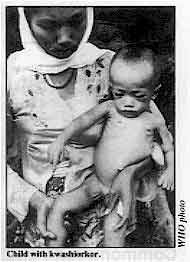 Child with kwashiorkor.