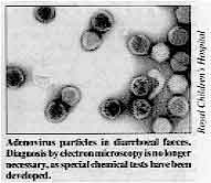 Adenovirus particles in diarrhoeal faeces. Diagnosis by electron microscopy is no longer necessary, as special chemical tests have been developed. 