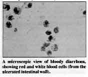 A microscopic view of bloody diarrhoea, showing red and white blood cells (from the ulcerated intestinal wall). 