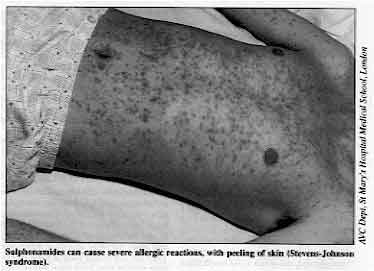 Sulphonamides can cause severe allergic reactions, with peeling of skin (Stevens-Johnson syndrome)